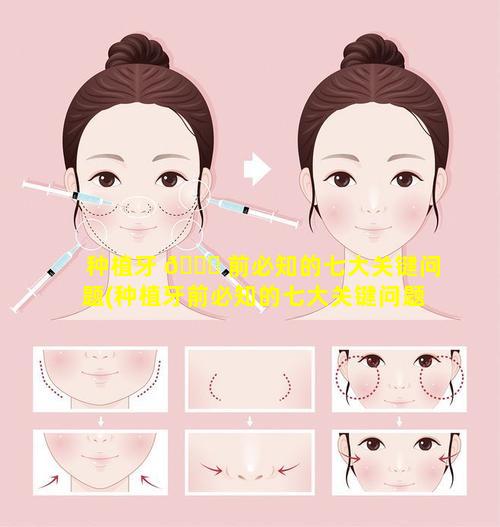 种植牙 🐘 前必知的七大关键问题(种植牙前必知的七大关键问题 🐦 有哪些)